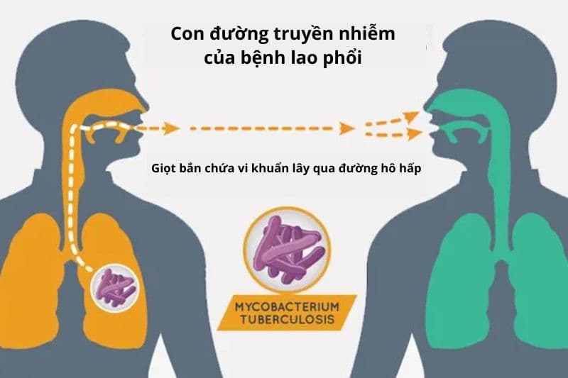 hiểu thêm nguyên nhân gây ra bệnh lao phổi là gì