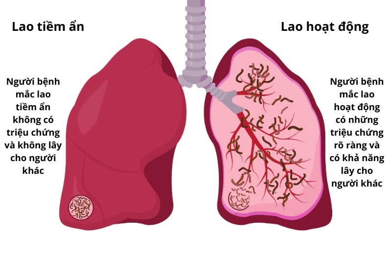 phân loại các giai đoạn lao phổi