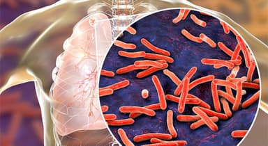 Góc giải đáp nguyên nhân gây ra bệnh lao phổi là gì