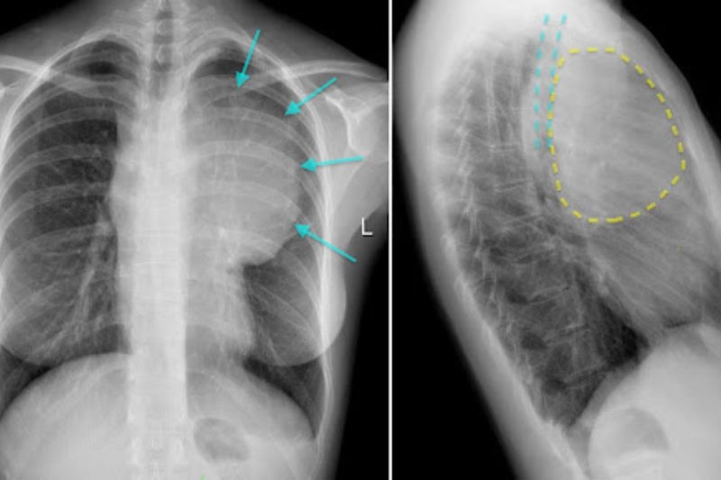 u hạch trung thất trước