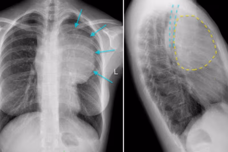 u hạch trung thất trước