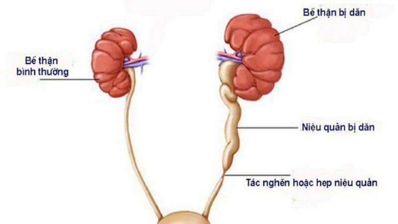 dòng chảy nước tiểu bị cản trở, đài bể thận sẽ giãn rộng do ứ đọng, tạo áp lực lớn lên nhu mô thận