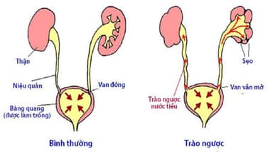Lý do giãn đài bể thận: Triệu chứng, cách phòng ngừa