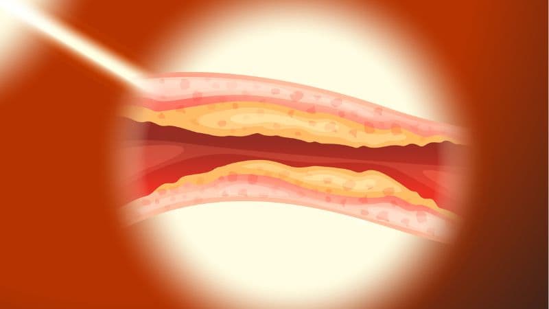 Mỡ máu cao là gì?