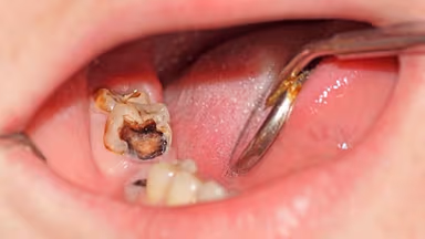 Mẹo giảm sưng sau khi nhổ hai răng sâu cùng lúc