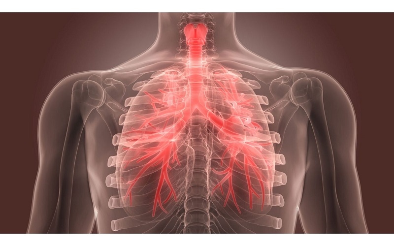 Giãn phế quản là tình trạng các ống phế quản trong phổi bị giãn bất thường