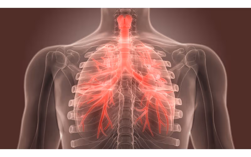 Giãn phế quản là tình trạng các ống phế quản trong phổi bị giãn bất thường