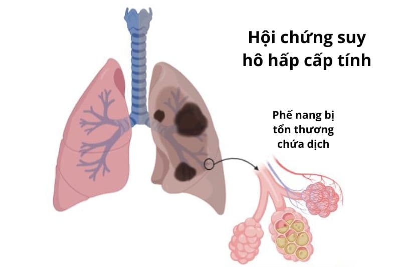 tìm hiểu về hội chứng suy hô hấp