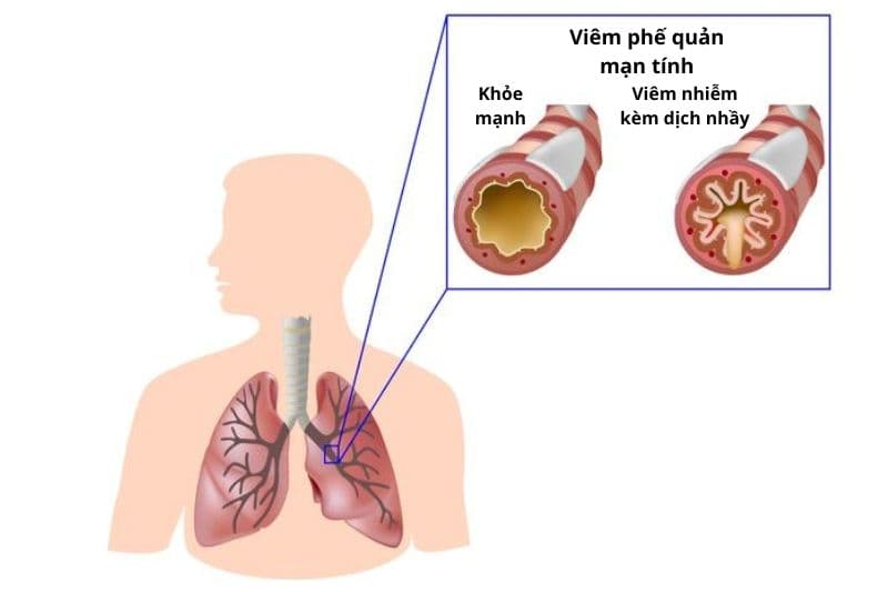 đợt cấp viêm phế quản mạn