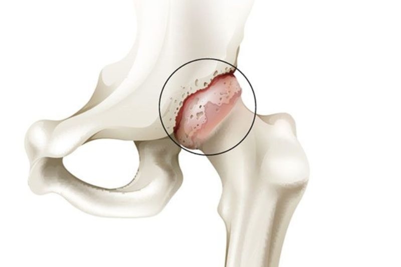 viêm thoái hóa khớp háng