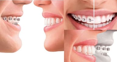 Niềng răng hay bọc sứ tốt hơn: Lời giải chuyên sâu từ A-Z