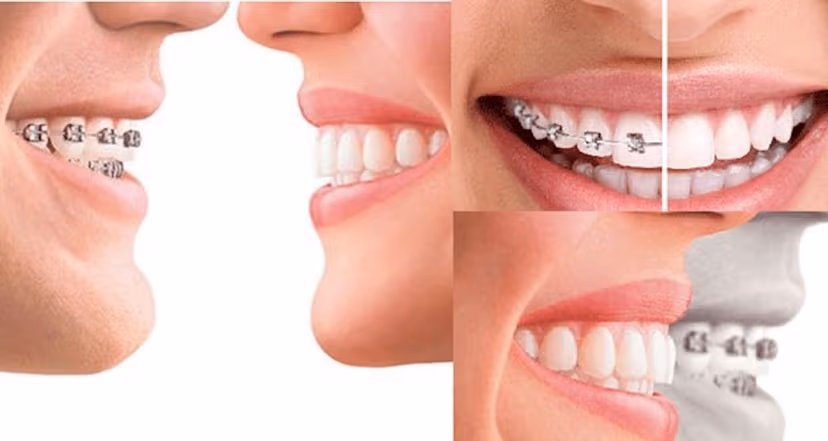 Niềng răng hay bọc sứ tốt hơn: Lời giải chuyên sâu từ A-Z