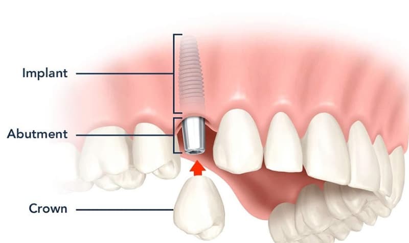 Răng cấy ghép Implant là phương pháp nha khoa hiện đại