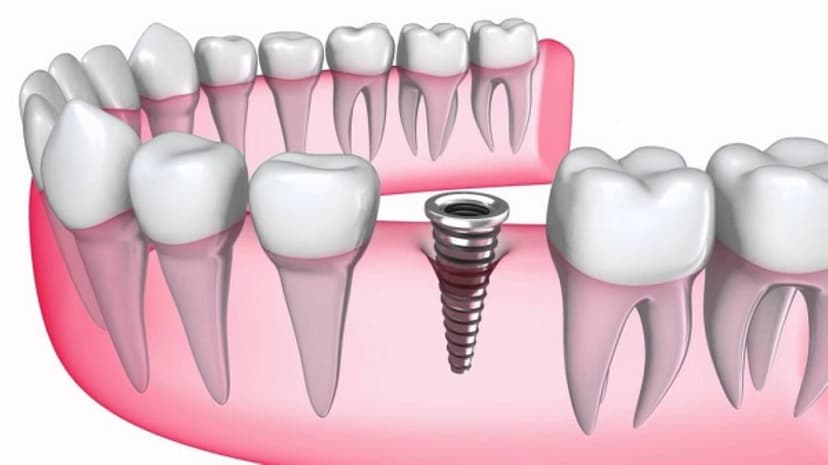 Bí quyết “vàng” cho tuổi thọ răng cấy ghép Implant