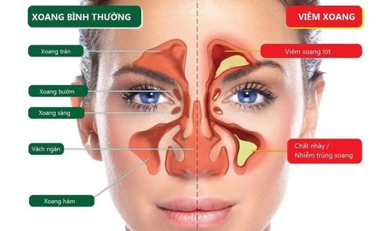 Sâu răng gây viêm xoang và dấu hiệu cảnh báo cần chú ý