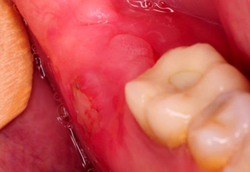Sưng lợi răng khôn là hiện tượng viêm nhiễm mô nướu quanh răng số 8 khi mọc, còn được gọi là viêm lợi trùm răng khôn.