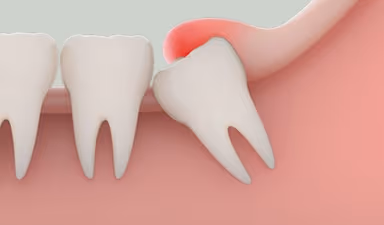 Sưng nướu răng khôn: Nguyên nhân và hướng điều trị hiệu quả