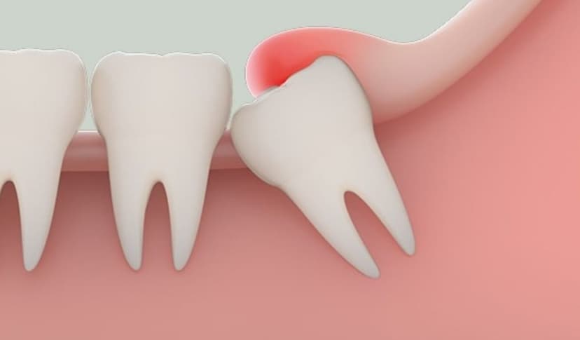 Sưng nướu răng khôn: Nguyên nhân và hướng điều trị hiệu quả