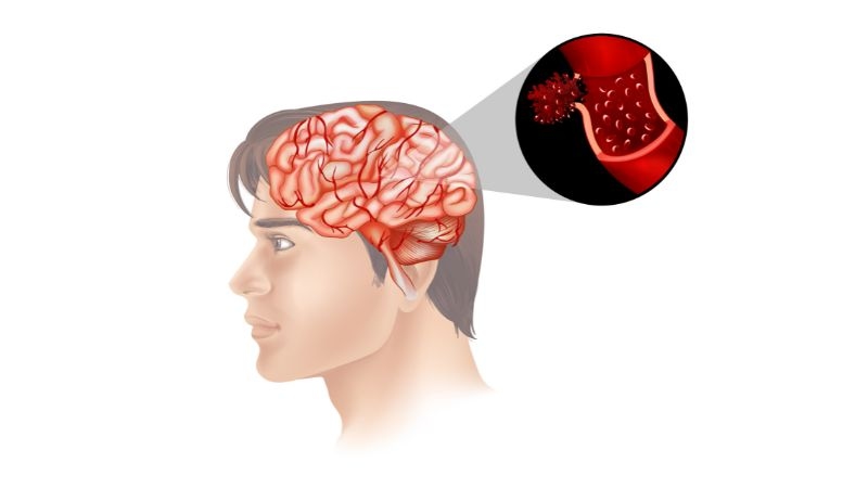 Sự cần thiết của việc phục hồi sau tai biến mạch máu não