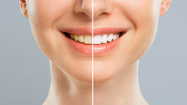 Top công nghệ tẩy trắng răng tại phòng khám siêu nhanh