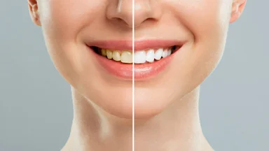 Top công nghệ tẩy trắng răng tại phòng khám siêu nhanh