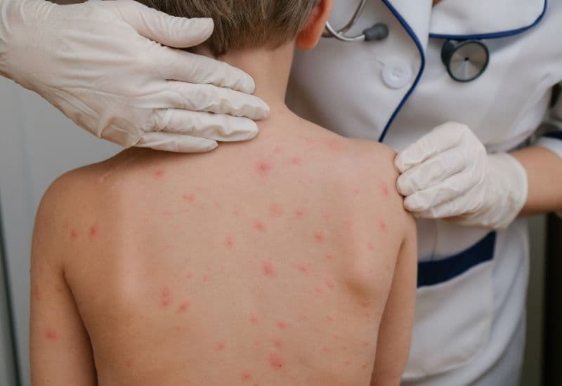 Thủy đậu do virus varicella-zoster gây ra, biểu hiện bằng sốt từ nhẹ đến vừa, mệt mỏi và các nốt phỏng nước lan từ mặt, thân ra tứ chi.