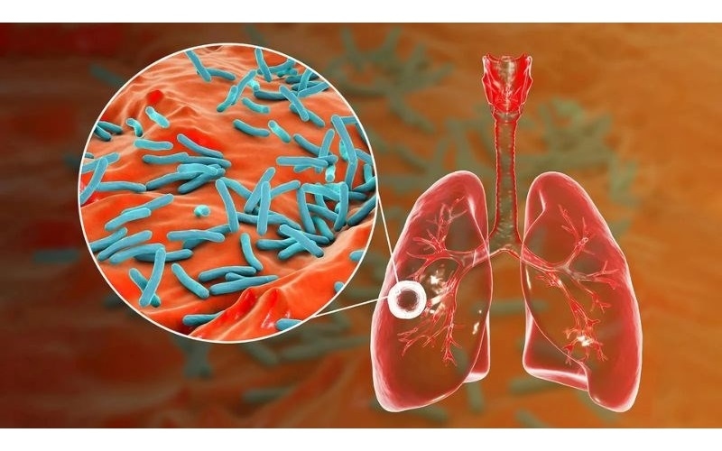 Khi người mắc lao phổi hoặc lao thanh quản ho, hắt hơi, nói chuyện hay cười lớn, họ phát tán vô số hạt khí dung chứa vi khuẩn ra môi trường