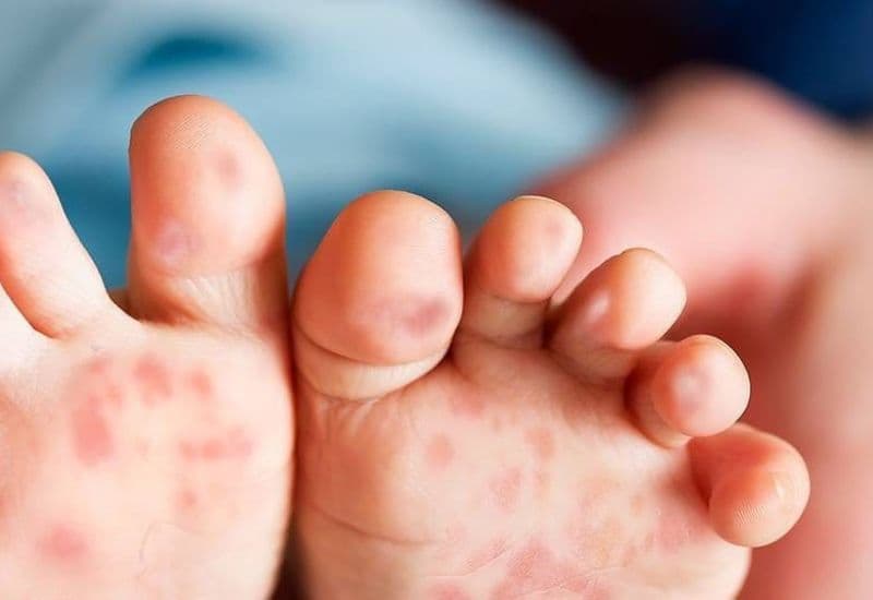 Bệnh tay chân miệng khá phổ biến ở trẻ, dễ khiến cha mẹ không khỏi lo âu.