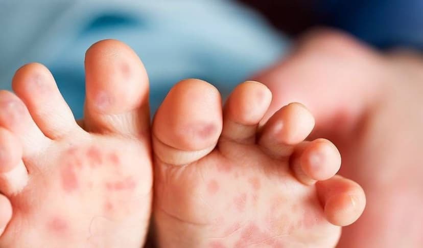 Trẻ bị tay chân miệng nên ăn gì để tăng cường sức đề kháng