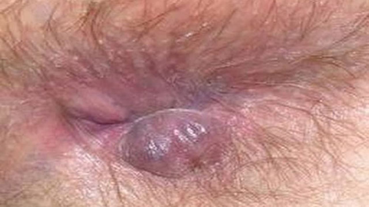 Trĩ ngoại có thể gây sưng đỏ, phù nề quanh hậu môn, đặc biệt khi búi trĩ to