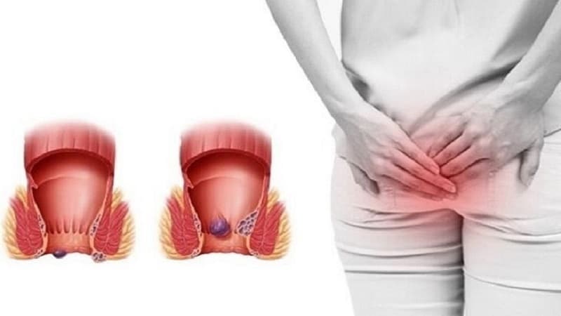 Điểm khác biệt cơ bản nhất giữa trĩ nội và trĩ ngoại chính là vị trí xuất hiện