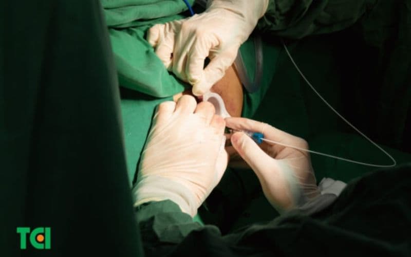 đốt trĩ Laser Diode là phương pháp mới, được đánh giá cao nhờ ưu điểm ít xâm lấn, hạn chế tối đa tình trạng đau và chảy máu