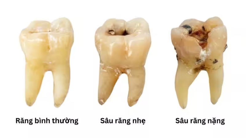 Trị sâu răng tận gốc: Tìm hiểu những nguyên nhân gây sâu răng