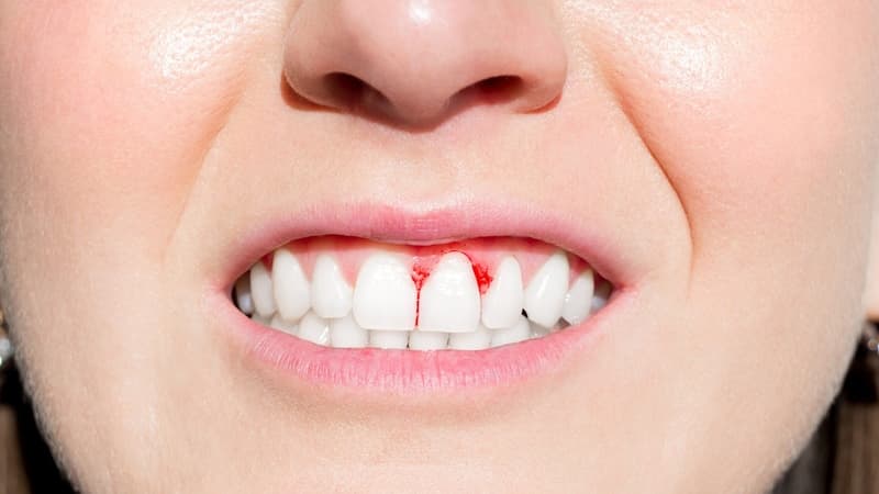 Viêm lợi chảy máu chân răng nguyên nhân do đâu