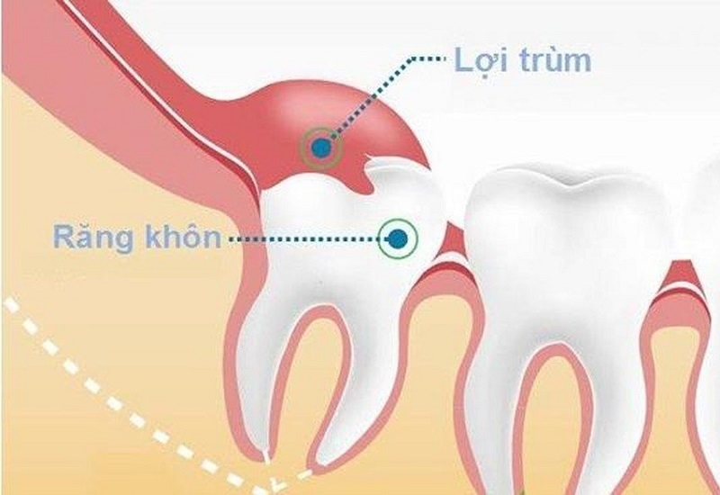Viêm lợi chùm răng khôn có chữa dứt điểm được không