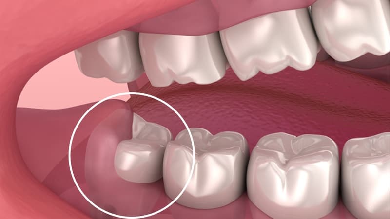 Viêm lợi chùm răng khôn: Những phương pháp cần lưu ý