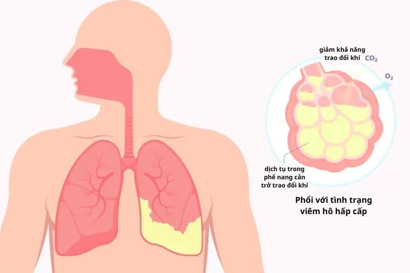 viêm phế quản cấp triệu chứng