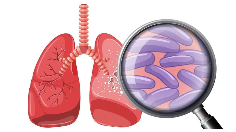 Yếu tố ảnh hưởng tới bệnh lao có chữa được không