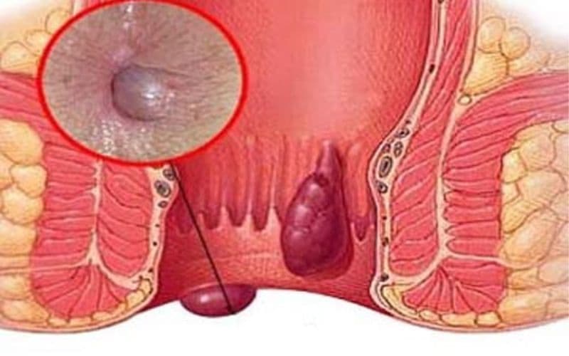 trĩ ngoại nằm ngoài, dễ nhận biết nhưng lại gây khó chịu nhiều hơn