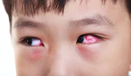 5 Phương pháp chữa bệnh đau mắt đỏ an toàn, hiệu quả