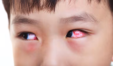 5 Phương pháp chữa bệnh đau mắt đỏ an toàn, hiệu quả