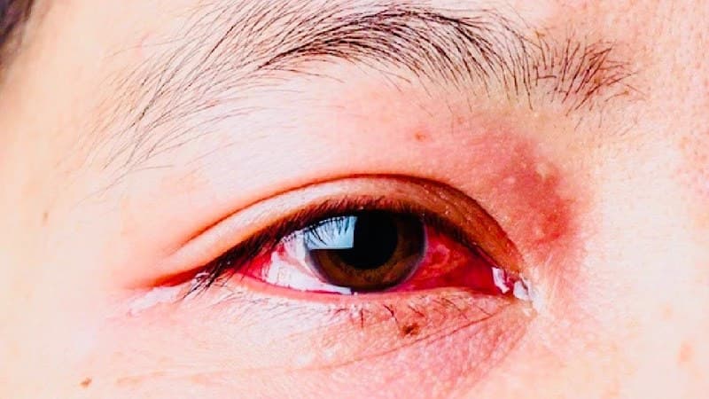 Chữa bệnh đau mắt đỏ: Những biến chứng nguy hiểm cần chú ý