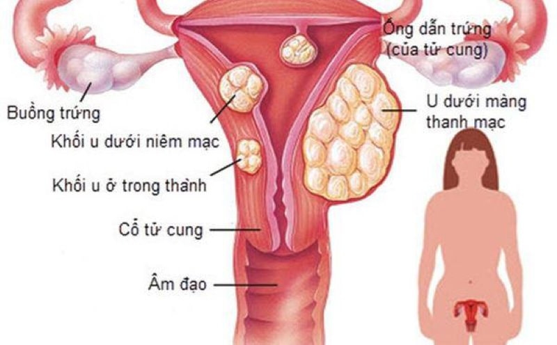 Chữa bệnh kinh nguyệt không đều: Những lưu ý chị em phụ nữ cần lưu ý về chu kỳ kinh nguyệt