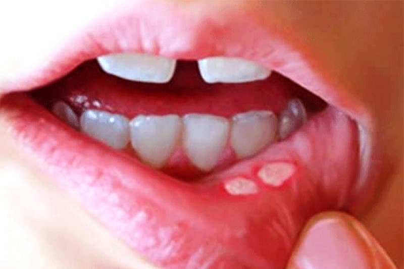 Cách để nhanh hết nhiệt miệng: Những lưu ý cần biết