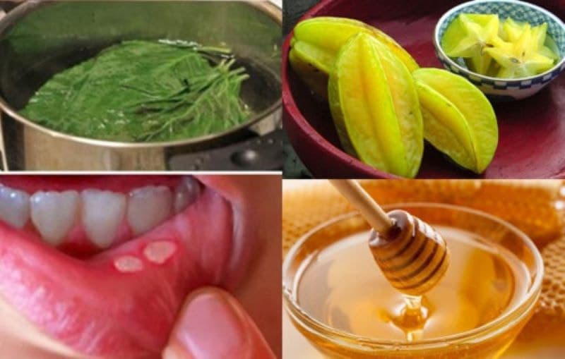 Cách để nhanh hết nhiệt miệng hiệu quả: Những cách áp dụng tại nhà đơn giản