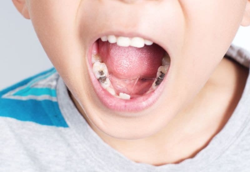 Dấu hiệu sâu răng ở trẻ là trên bề mặt răng xuất hiện những vết trắng hoặc nâu.