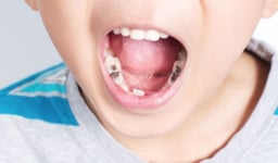 7 Dấu hiệu sâu răng ở trẻ mà cha mẹ cần biết