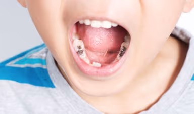 7 Dấu hiệu sâu răng ở trẻ mà cha mẹ cần biết