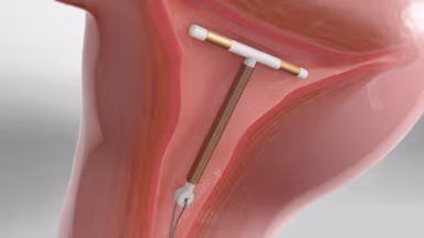 7 Lưu ý sau khi đặt vòng tránh thai chị em cần biết