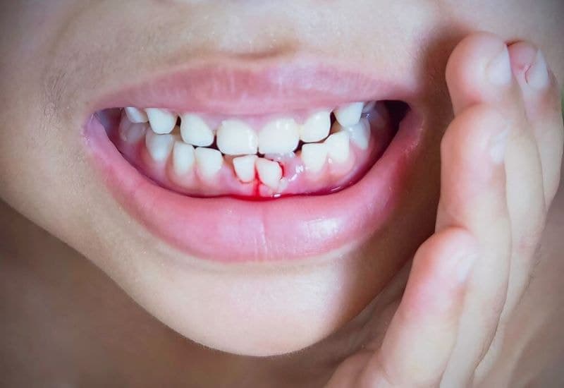 Bé 2 tuổi bị sưng lợi dẫn đến lợi chảy máu